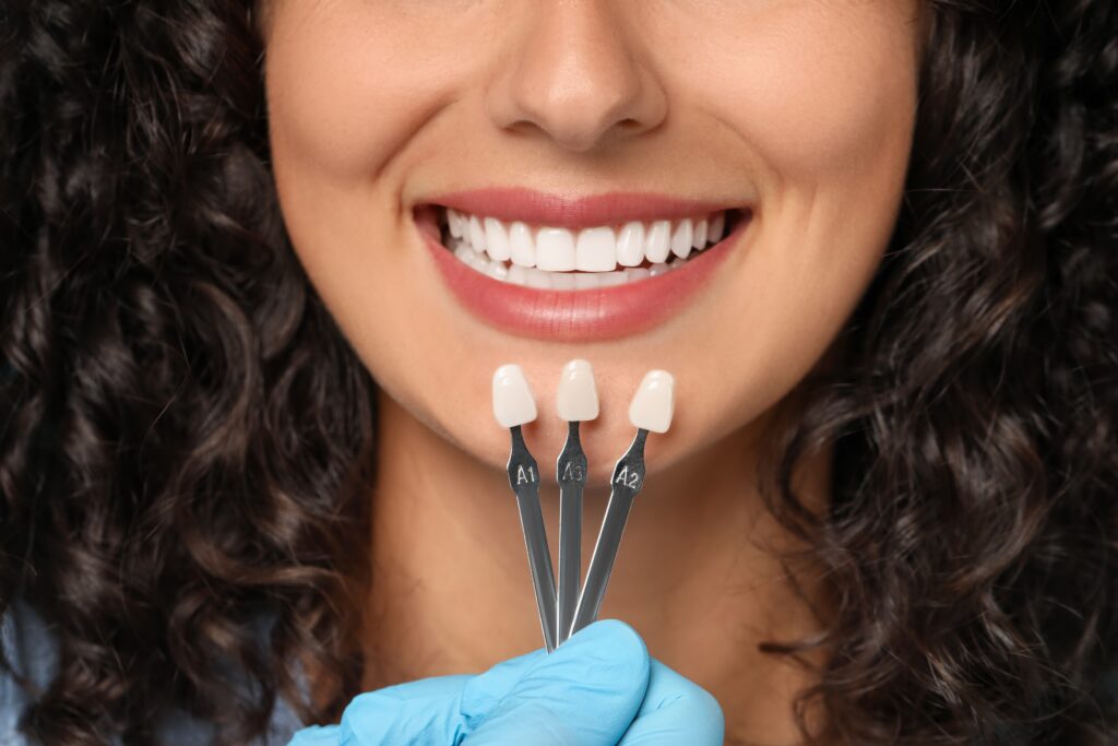 Dental Veneers Odessa